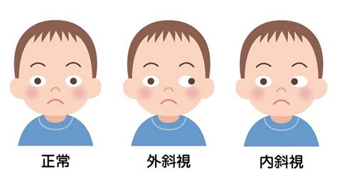 斜視|斜視の症状や原因、治療法とは？ 